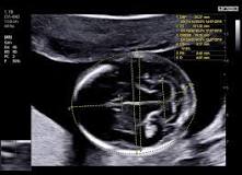 ecografia semana 16 de embarazo