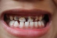 agujero en el diente