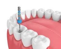 empaste o endodoncia