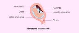 hematoma en utero en el embarazo