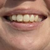 manchas blancas dientes niños